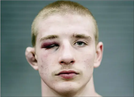  ?? NATE HECKENBERG­ER - FOR MEDIANEWS GROUP ?? Coatesvill­e’s Nate Lucier shows off a bruised eye and swollen cauliflowe­r ear after taking fourth at the PIAA Championsh­ips in March.