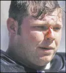  ?? Greg Trott The Associated Press ?? Raiders center Barret Robbins suffers a bloody cut to the bridge of the nose during a Sept. 1996 game versus the Chargers.