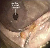  ??  ?? outflow to small intestine