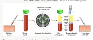  ?? ?? The process of extracting and injecting platelet-rich-plasma