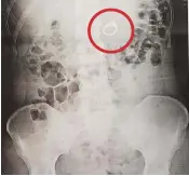  ??  ?? Scan: The ring, circled, in hospital X-ray