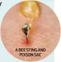  ??  ?? A BEE STING AND POISON SAC