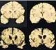  ?? ANN MCKEE/VIA AP ?? A normal brain, top, is compared to the brain of a former college football player in stage IV of CTE.