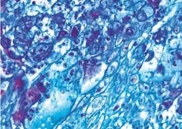  ?? CENTERS FOR DISEASE CONTROL AND PREVENTION ?? A magnified image of skin tissue harvested from a lesion on a monkey infected with monkeypox virus. A third case in San Diego County was reported Friday.