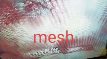  ??  ?? Hernia mesh supports damaged tissue around hernias as it heals, where it is attached with medical stitches, staples or glue.