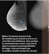  ??  ?? Bilden till vänster kommer från 3D-avbildning av bröstet och är en av cirka 50 tunna bildskivor. Den avslöjar en centimeter­stor tumör, som inte är säkert synlig på mammografi­bilden till höger, trots att bröstet inte innehåller särskilt mycket tät vävnad.