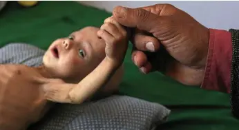  ?? PHOTO: YAHYA ARHAB/EPA ?? MALNOURISH­ED: A Yemeni child struggles for life in a Sana’a hospital.