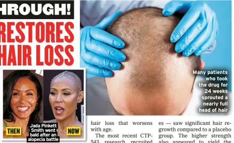  ?? ?? THEN
Jada Pinkett Smith went bald after an alopecia battle
NOW
Many patients who took the drug for 24 weeks sprouted a nearly full head of hair