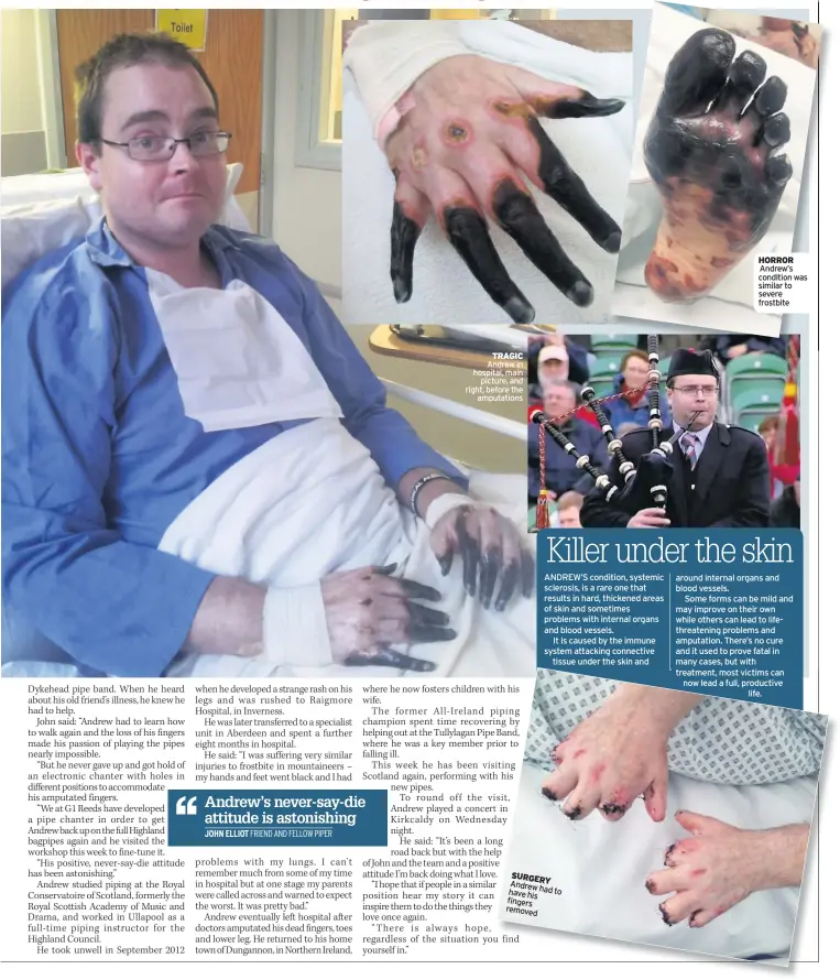  ??  ?? TRAGIC Andrew in hospital, main picture, and right, before the amputation­s SURGERY Andrew have had to his fingers removed HORROR Andrew’s condition was similar to severe frostbite