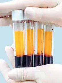  ??  ?? Prp
È l’acronimo di Platelet-Rich Plasma (letteralme­nte plasma ricco di piastrine che serve per rigenerare gli arti