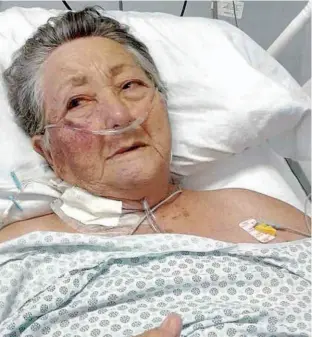  ?? Arquivo pessoal ?? A dona de casa Thereza de Jesus Garcia, 78 anos, com o rosto machucado, no leito da UTI do Hospital do Servidor Público Municipal, que abriu sindicânci­a