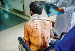  ?? —AP ?? A Kashmiri man with his pellet ridden back sits on wheelchair at a hospital after he was injured in a clash in Srinagar, Kashmir on Tuesday.