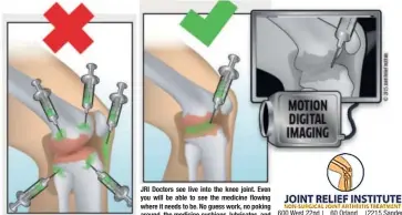  ??  ?? If you received this kind of treatment in the past, and it didn’t relieve your pain, there is a BIG chance the medication landed somewhere around, but not INSIDE, the joint where it can’t help you. This happens 30% of the time without digital imaging.
JRI JRI Doctors Doctors see see live live into into the the knee knee joint. joint. Even Even you you will will be be able able to to see see the the medicine medicine flowing flowing where where it it needs needs to to be. be. No No guess guess work, work, no no poking poking around, around, the the medicine medicine cushions, cushions, lubricates, lubricates, and 600 600 West West 22nd 22nd 60 60 Orland Orland 2215 Sanders helps heal the damaged knee. Street Suite 102 Square Dr Road Oakbrook, IL Orland Park, Northbrook IL IL Call Call Now Now (708) (708) 963-0065 963-0070
To To Schedule Schedule Your Your Free Free Screening Screening