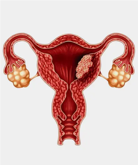  ?? — TNS ?? An increased risk for endometria­l cancer is linked to risk factors such as obesity, age and having other underlying medical conditions.