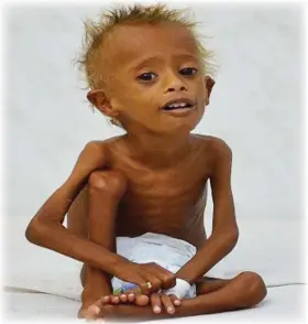  ??  ?? طفل يمني يعاني من سوء التغذية بسبب انتهاكات ميليشيا الحوثي ونهبها للمساعدات وحصارها للمدن. (أرشيفية)
