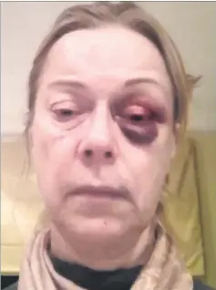  ?? Picture: Surrey Police ?? Susan Morris was left with a black eye during her ordeal at the hand of the ‘Night Watcher’