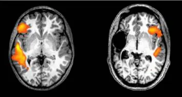  ??  ?? These fMRI scans show the brain activity of a healthy person (left) and a stroke patient (right) while doing a language-related task. Having a stroke just before or after being born flips key language-processing areas from the left to the right side of...