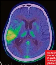  ?? ?? Promising results: a scan of a patient in the phase I glioblasto­ma trial before treatment and three months after treatment.