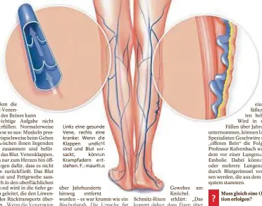  ??  ?? Links eine gesunde Vene rechts eine kranke Wenn d e Klappen undicht sind und Blut ver sackt können Krampfader­n ent stehen F mauritus