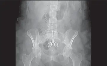  ??  ?? An X-ray shows a pair of surgical scissors in the abdomen of a woman in France who complained of abdominal pain after surgery. Similar incidents happen in Canada.