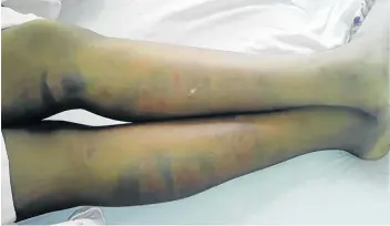  ?? Picture: SUPPLIED ?? MARKS OF CRUELTY: A Lusikisiki pupil is in hospital after she was allegedly beaten by the school deputy principal on Monday. She has since missed three exams.