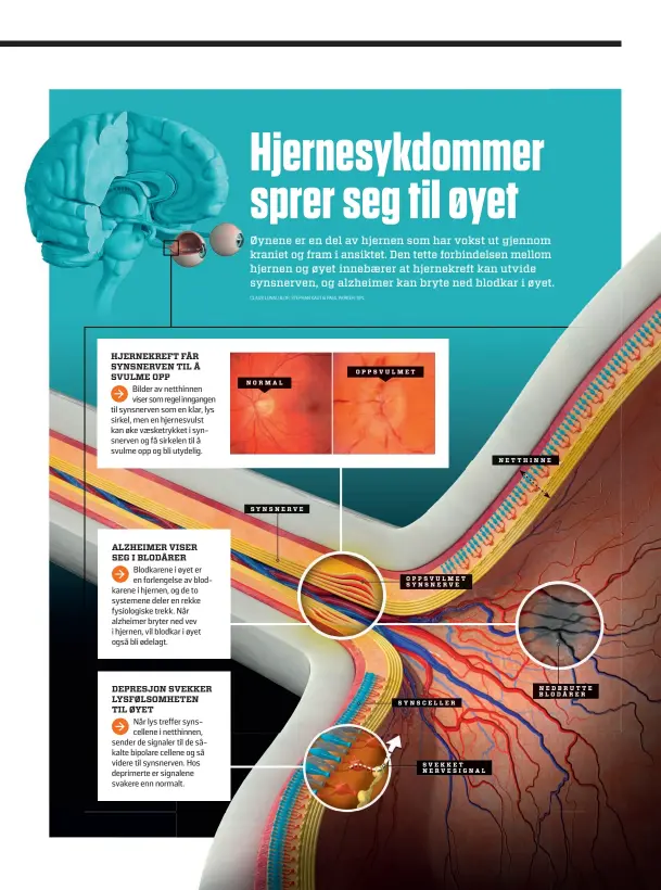  ??  ?? NORMAL SYNSNERVE OPPSVULMET OPPSVULMET SYNSNERVE SYNSCELLER SVEKKET NERVESIGNA­L NETTHINNE NEDBRUTTE BLODÅRER