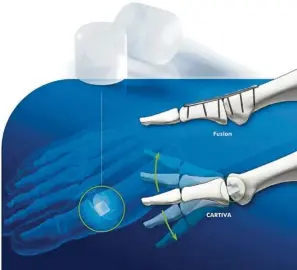  ?? — Photos: TNS ?? The Cartiva Synthetic Cartilage Implant was approved by the FDA in July 2016 to treat big-toe arthritis.