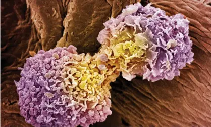  ?? Photograph: Steve Gschmeissn­er/Getty/Science Photo Library RM ?? Coloured scanning electron micrograph of dividing breast cancer cells.