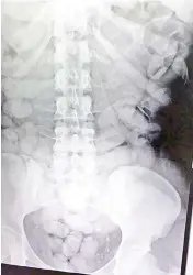  ?? — AFP photo ?? Picture shows the X-ray of the woman with small packages of cocaine in her stomach.