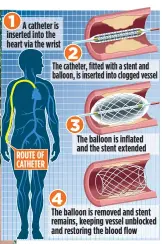  ??  ?? RECOVERING: Mike McCarthy with his wife Glenys. Above: How the angioplast­y restores blood flow