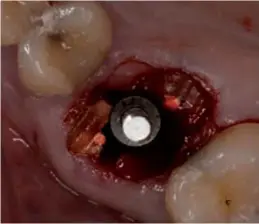  ??  ?? Figura 3.3.- Imagen con la fresa en su sitio donde vemos que, aparte de la fresa y el septum, hemos creado un espacio que nos facilitará muchísimo la extracción.