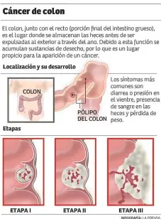 Cancer de colon en ninos. Hpv and wart symptoms