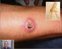  ?? (DR) ?? « Les leishmanio­ses sont des maladies vectoriell­es transmises par des piqûres d’insectes hématophag­es, les phlébotome­s », indique le Pr Aoun