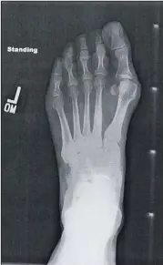  ??  ?? An X-ray before Diane Frame’s “mini-tightrope” surgery for bunions. | SUBMITTED PHOTOS