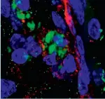  ?? ?? På billedet ses en mikroskopi af lugtenerve­n på mus. Bakterien chlamydia pneumoniae (grøn) inficerer hjernecell­erne (blå) og skaber en ophobning af proteinet beta amyloid (rød).