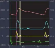  ??  ?? 注：红色为P波，蓝色为U波，黄色为WI波，绿色为模拟心电图
图 2平和脉WI图像