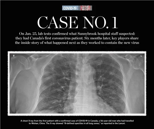  ??  ?? A chest X-ray from the first patient with a confirmed case of COVID-19 in Canada, a 56-year-old man who had travelled to Wuhan, China. The X-ray showed “ill-defined opacities in all lung zones,” as reported in the Lancet.