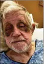  ?? CONTRIBUTE­D ?? John Sexton’s family provided this image after he was injured as a patient at Wood Glen Alzheimer’s Community in Miami Twp.