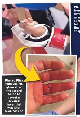  ??  ?? Khetag Pliev removed his glove after the second round to reveal a severed finger that was later sewn back on