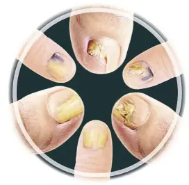  ??  ?? Nailner is a non-drug topical treatment that treats nail fungus effectivel­y with a proven 95% recovery rate.