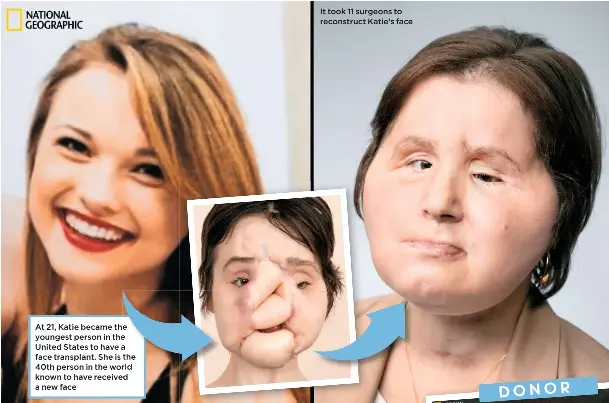  ??  ?? At 21, Katie became the youngest person in the United States to have a face transplant. She is the 40th person in the world known to have received a new face