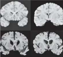 ?? ANN MCKEE, MD, THE ASSOCIATED PRESS ?? This combinatio­n of photos provided by Boston University shows sections from a normal brain, top, and from the brain of former University of Texas football player Greg Ploetz, bottom, in stage IV of chronic traumatic encephalop­athy.