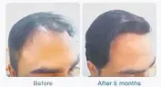  ??  ?? This client can now sport more versatile hairstyles, five months after undergoing a hair transplant.