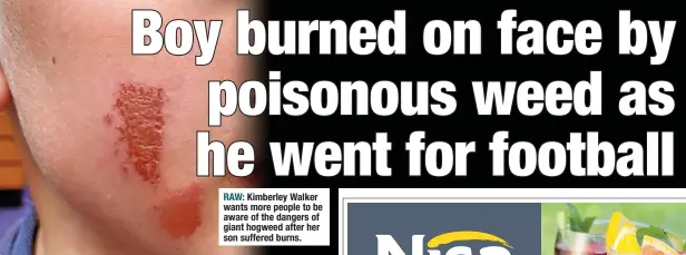  ?? ?? RAW: Kimberley Walker wants more people to be aware of the dangers of giant hogweed after her son suffered burns.