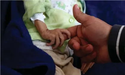  ?? Photograph: Xinhua/REX/Shuttersto­ck ?? A malnourish­ed child at Al-Sabeen hospital in Sana’a, Yemen, November 2020.