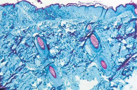  ?? ?? La viruela de los
monos. Los lectores buscan estos días informació­n
contrastad­a sobre la expansión de este virus
(en la imagen)