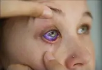  ?? JUSTIN TANG, THE CANADIAN PRESS ?? Catt Gallinger, who had a botched ink injection in her eyeball, shows the amount of swelling in her eye at her home in Ottawa on Friday.
