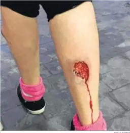  ?? SONIA RAMOS ?? Una de las profundas heridas sufrida por la mujer tras el ataque de los perros.