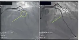 ??  ?? Ci-dessus à gauche, on voit clairement le rétrécisse­ment de l’artère coronaire. À droite :  minutes plus tard, après l’interventi­on, l’artère a retrouvé une taille adéquate, éliminant un gros risque pour le patient.