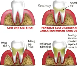  ?? PENYAKIT GUSI DISEBABKAN JANGKITAN KUMAN PADA GUSI ?? Poket gigi Tulang gigi rosak Keradangan Kehilangan tulang gigi karang gigi Poket gusi semakin dalam memberi ruang kepada bakteria untuk hidup